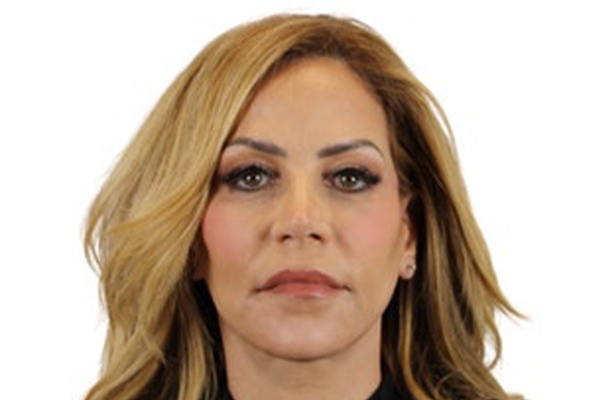 Facelift - Before/After After