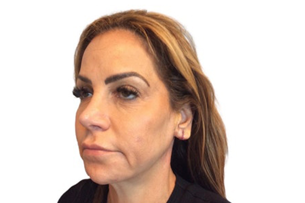 Facelift - Before/After Before