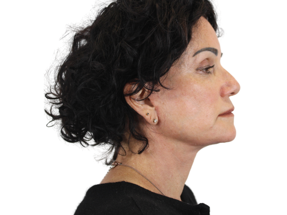 Deep Plane Facelift Before & After Gallery - Patient 53824270 - Image 6