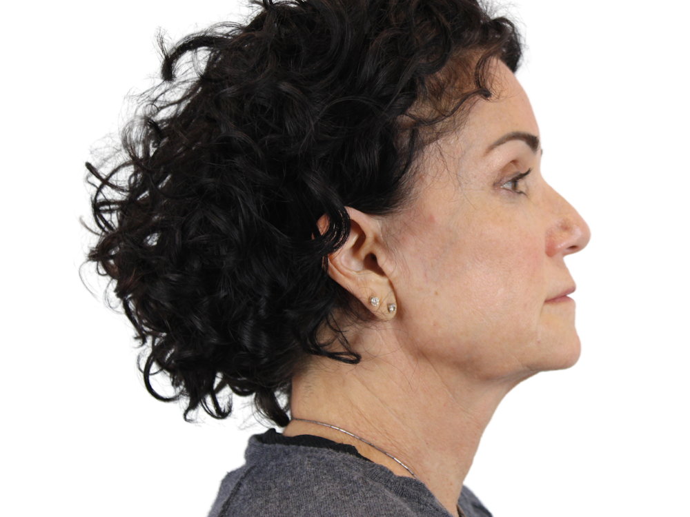 Facelift Before & After Gallery - Patient 53824270 - Image 5