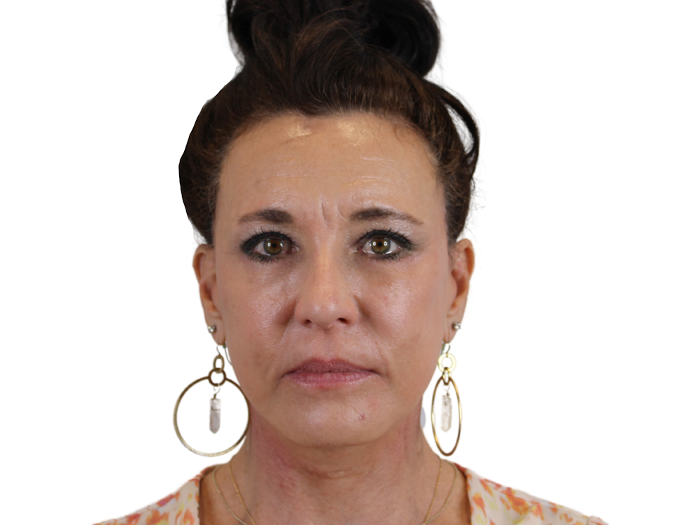 Facelift Before & After Gallery - Patient 53824493 - Image 2