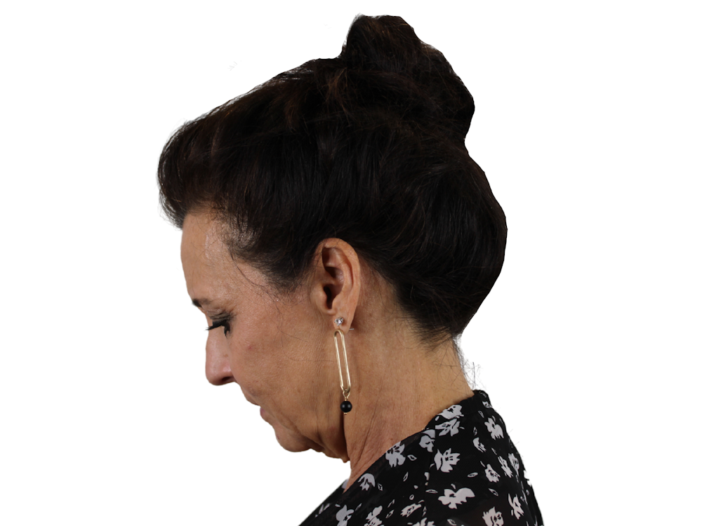 Deep Plane Facelift Before & After Gallery - Patient 53824493 - Image 5