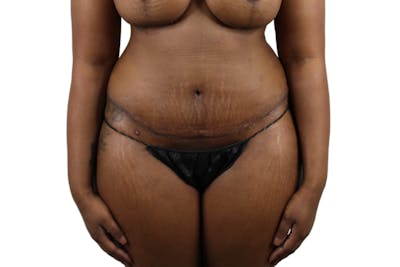 Abdominoplasty Before & After Gallery - Patient 53824845 - Image 2