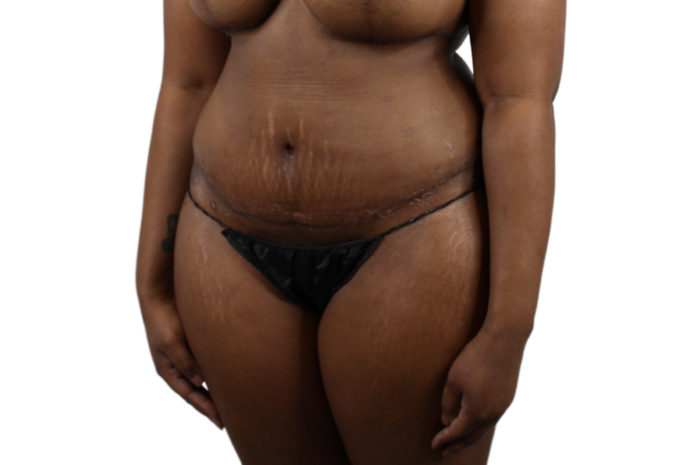 Abdominoplasty Before & After Gallery - Patient 53824845 - Image 6