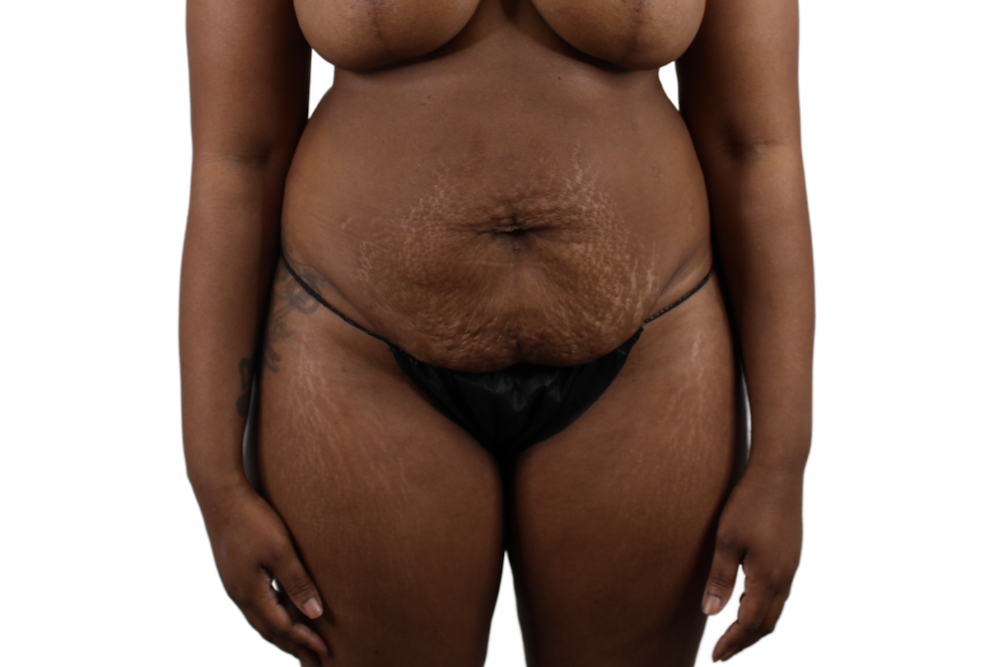 Abdominoplasty Before & After Gallery - Patient 53824845 - Image 1
