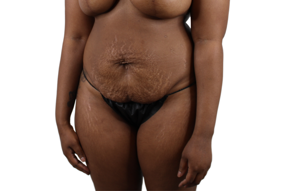 Abdominoplasty Before & After Gallery - Patient 53824845 - Image 5