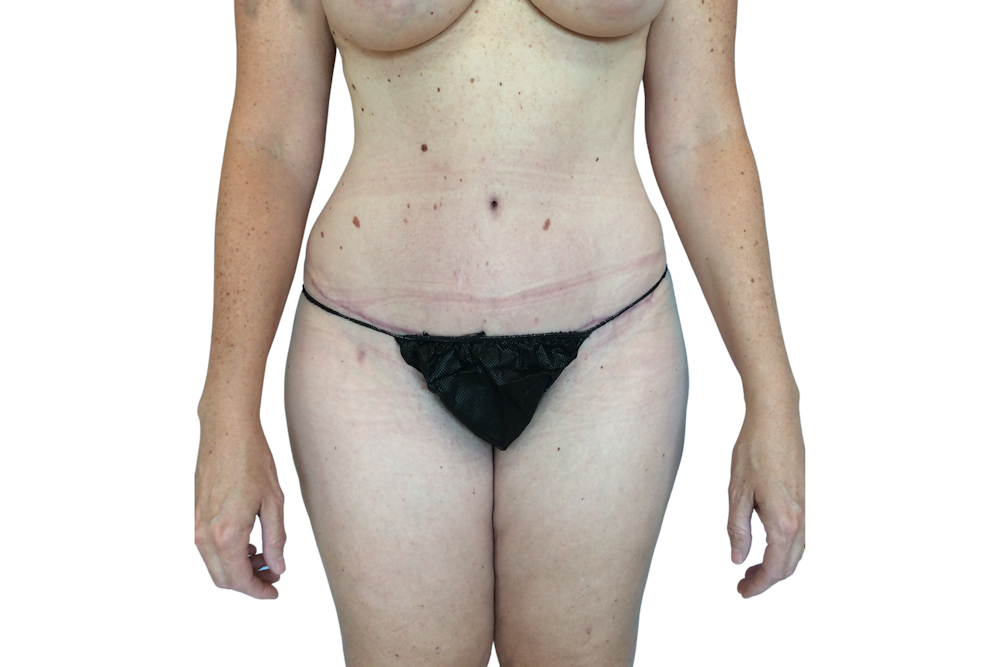 Abdominoplasty Before & After Gallery - Patient 53824876 - Image 2