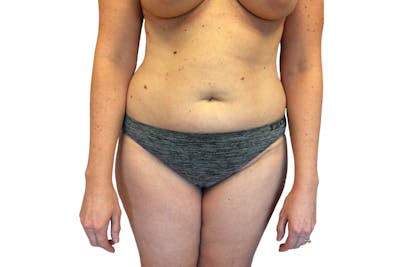 Abdominoplasty Before & After Gallery - Patient 53824876 - Image 1