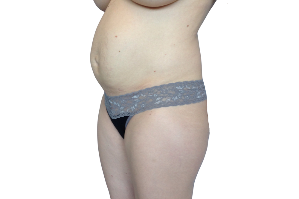 Abdominoplasty Before & After Gallery - Patient 53824926 - Image 3