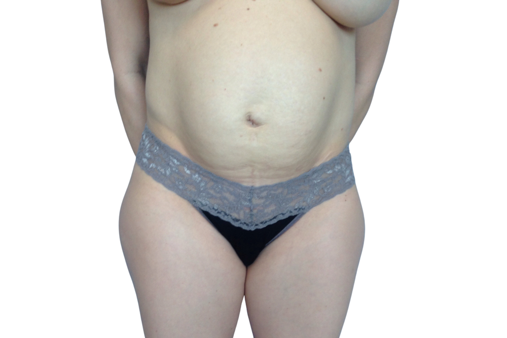 Abdominoplasty Before & After Gallery - Patient 53824926 - Image 1