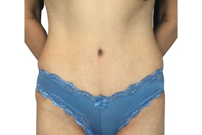Abdominoplasty Before & After Gallery - Patient 53824988 - Image 2