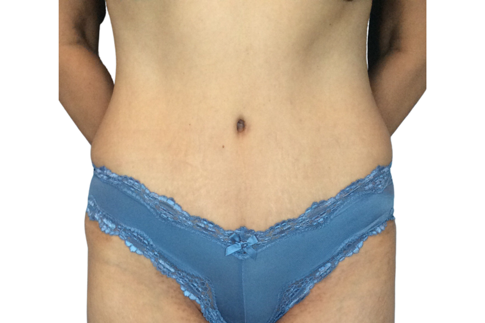 Abdominoplasty Before & After Gallery - Patient 53824988 - Image 2