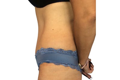 Abdominoplasty Before & After Gallery - Patient 53824988 - Image 6
