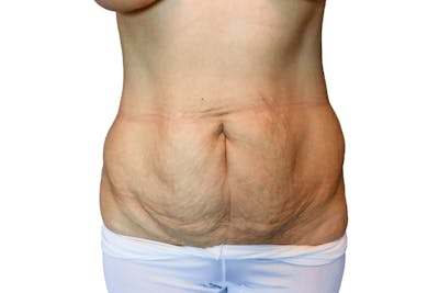 Abdominoplasty Before & After Gallery - Patient 53824988 - Image 1
