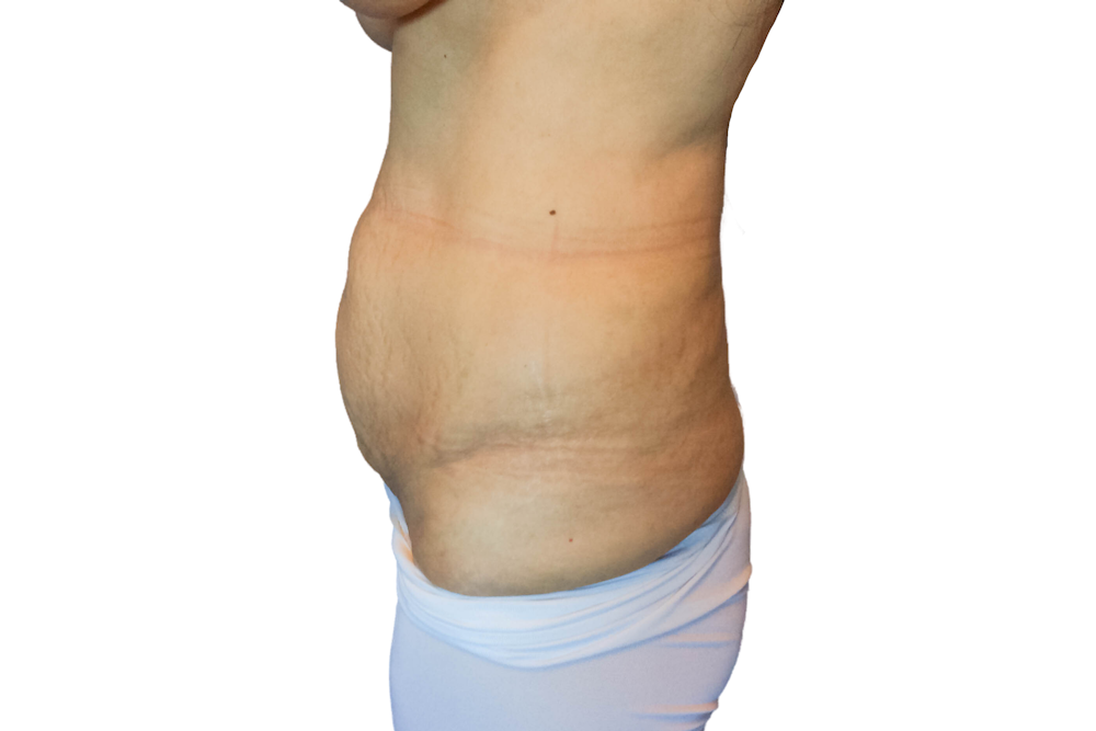 Abdominoplasty Before & After Gallery - Patient 53824988 - Image 5