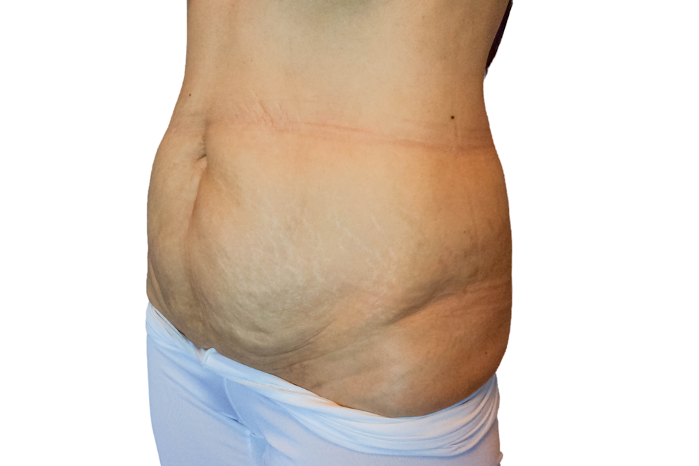 Abdominoplasty Before & After Gallery - Patient 53824988 - Image 3