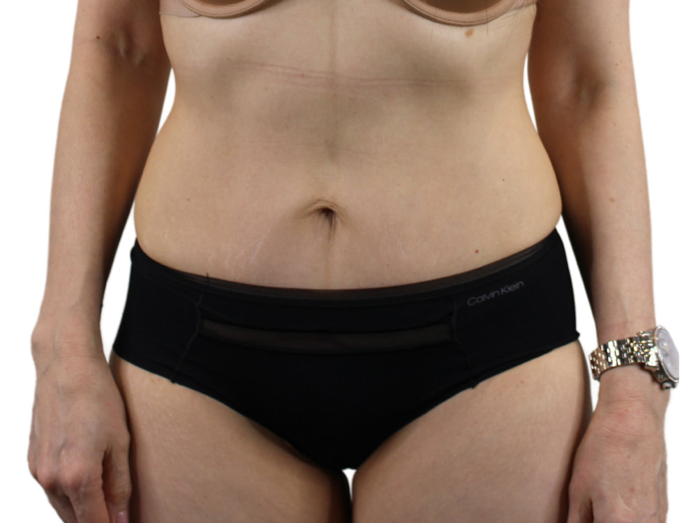 Abdominoplasty Before & After Gallery - Patient 53825108 - Image 2