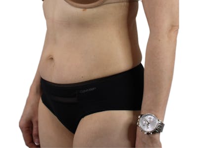 Abdominoplasty Before & After Gallery - Patient 53825108 - Image 4