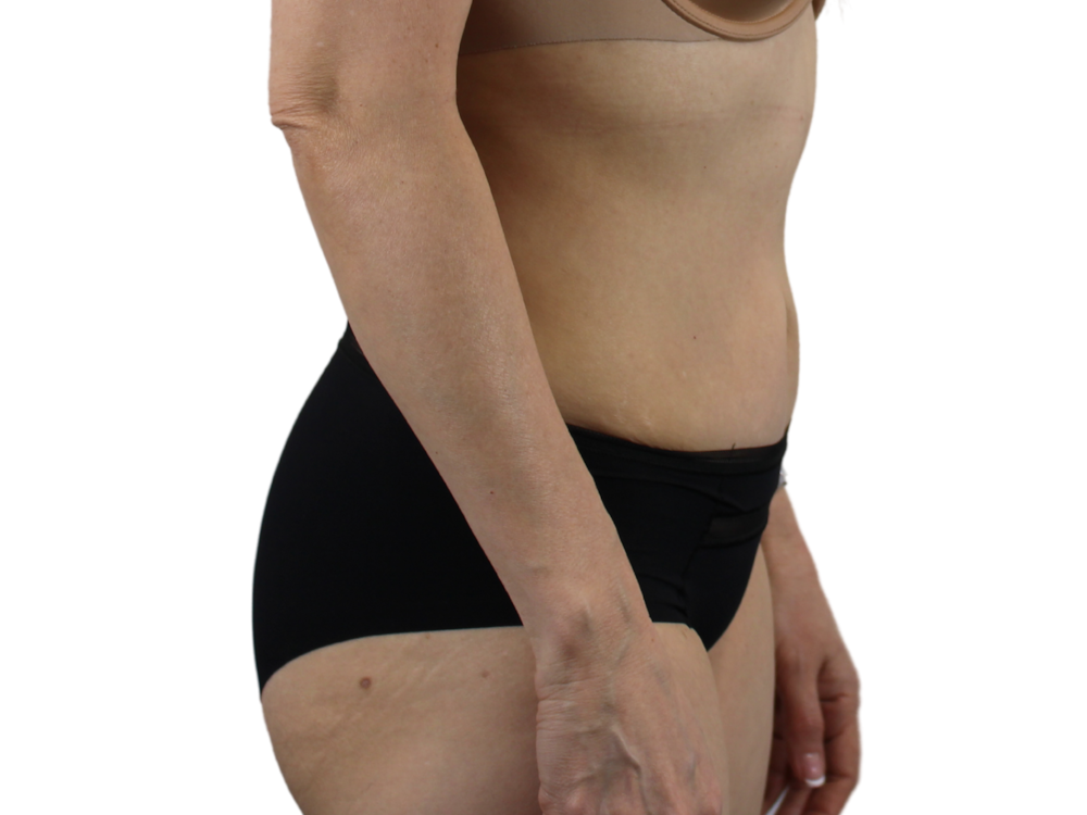 Abdominoplasty Before & After Gallery - Patient 53825108 - Image 6