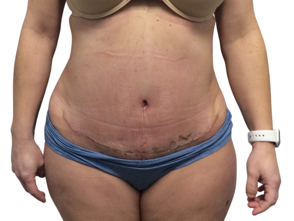 Abdominoplasty Before & After Gallery - Patient 53825156 - Image 2