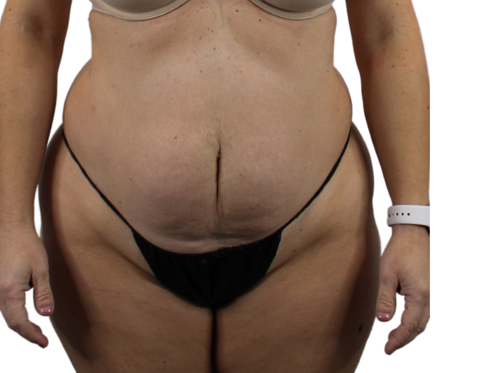 Abdominoplasty Before & After Gallery - Patient 53825156 - Image 1