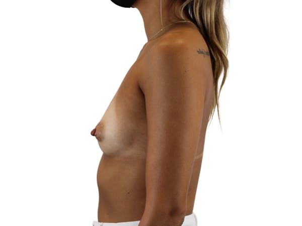 Breast Augmentation Gallery - Patient 53827843 - Image 5