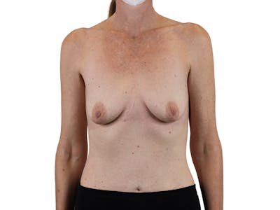 Breast Augmentation Before & After Gallery - Patient 53827870 - Image 1