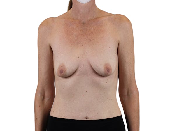 Breast Augmentation Gallery - Patient 53827870 - Image 1