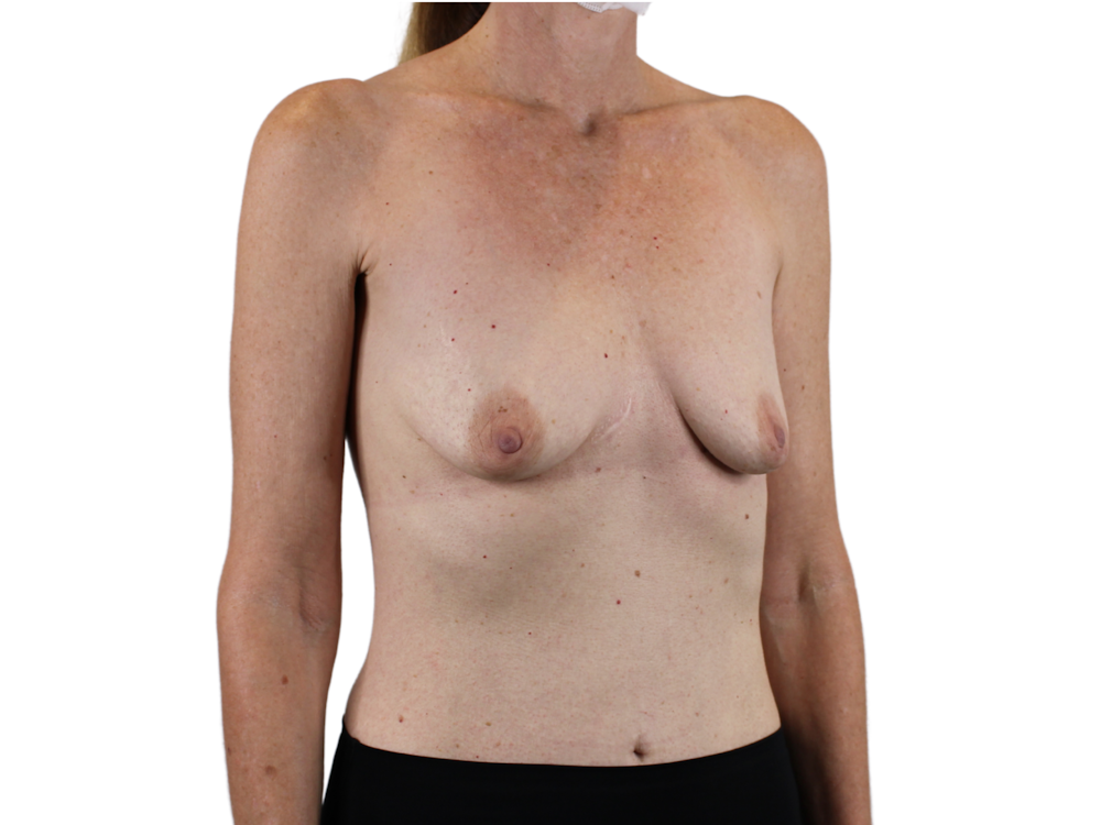 Breast Augmentation Before & After Gallery - Patient 53827870 - Image 3