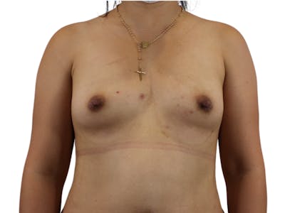 Breast Augmentation Before & After Gallery - Patient 53827885 - Image 1