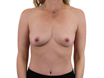 Breast Augmentation Before & After Gallery - Patient 53828160 - Image 1