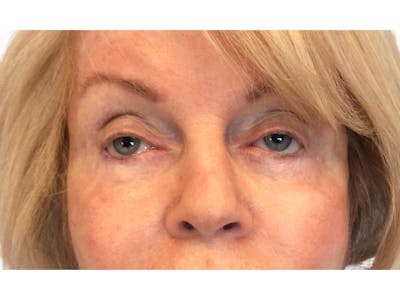 Blepharoplasty Before & After Gallery - Patient 53828330 - Image 2