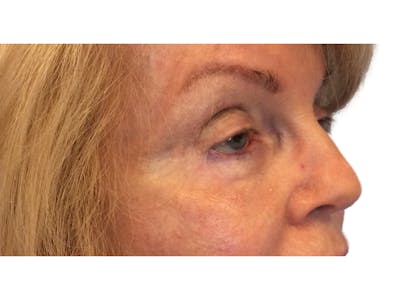Blepharoplasty Before & After Gallery - Patient 53828330 - Image 4