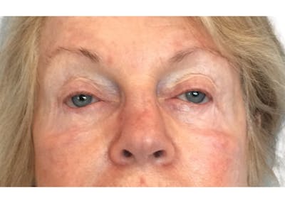 Blepharoplasty Before & After Gallery - Patient 53828330 - Image 1