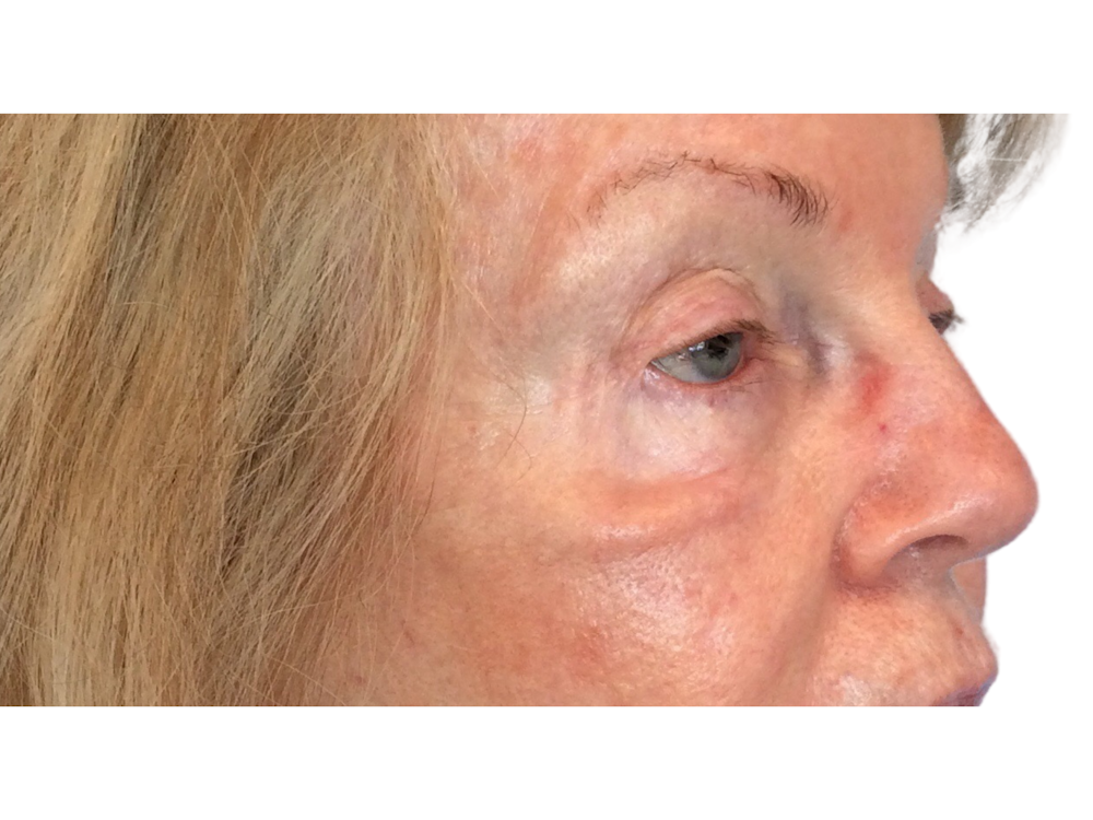 Blepharoplasty Before & After Gallery - Patient 53828330 - Image 3