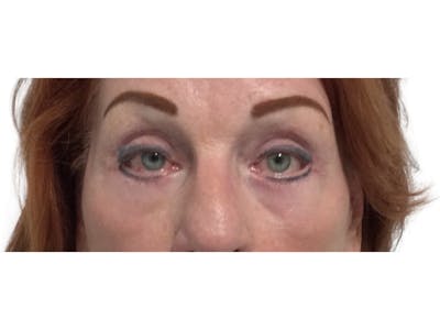Blepharoplasty Before & After Gallery - Patient 53828393 - Image 2