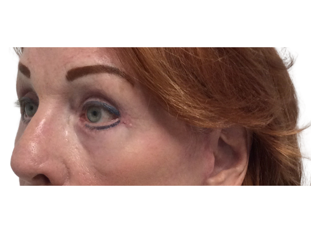 Blepharoplasty Before & After Gallery - Patient 53828393 - Image 4