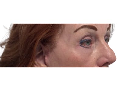 Blepharoplasty Before & After Gallery - Patient 53828393 - Image 6