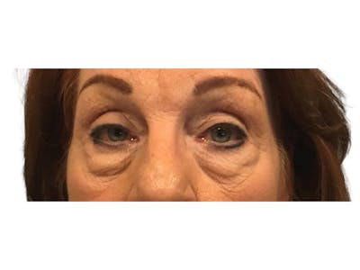 Blepharoplasty Before & After Gallery - Patient 53828393 - Image 1