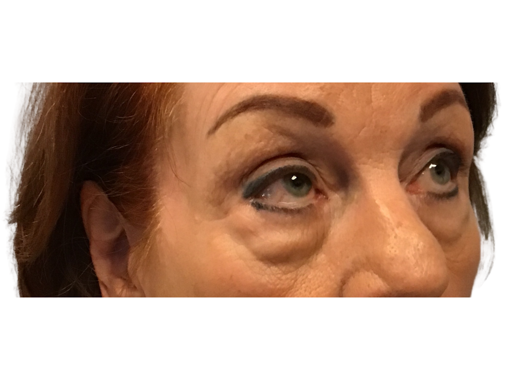 Blepharoplasty Before & After Gallery - Patient 53828393 - Image 5