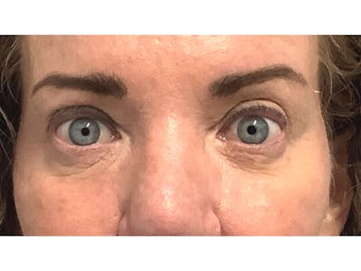 Blepharoplasty Before & After Gallery - Patient 53828415 - Image 2