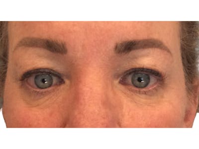 Blepharoplasty Before & After Gallery - Patient 53828415 - Image 1
