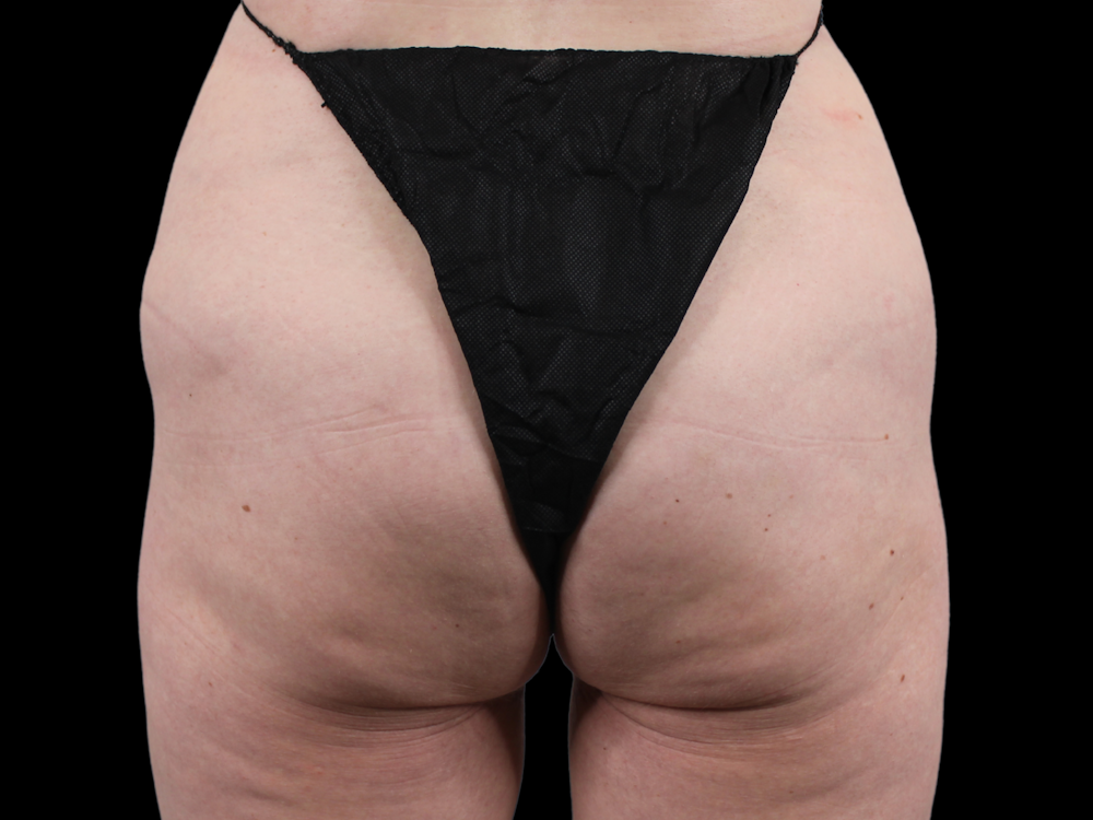 QWO Before & After Gallery - Patient 53828573 - Image 2