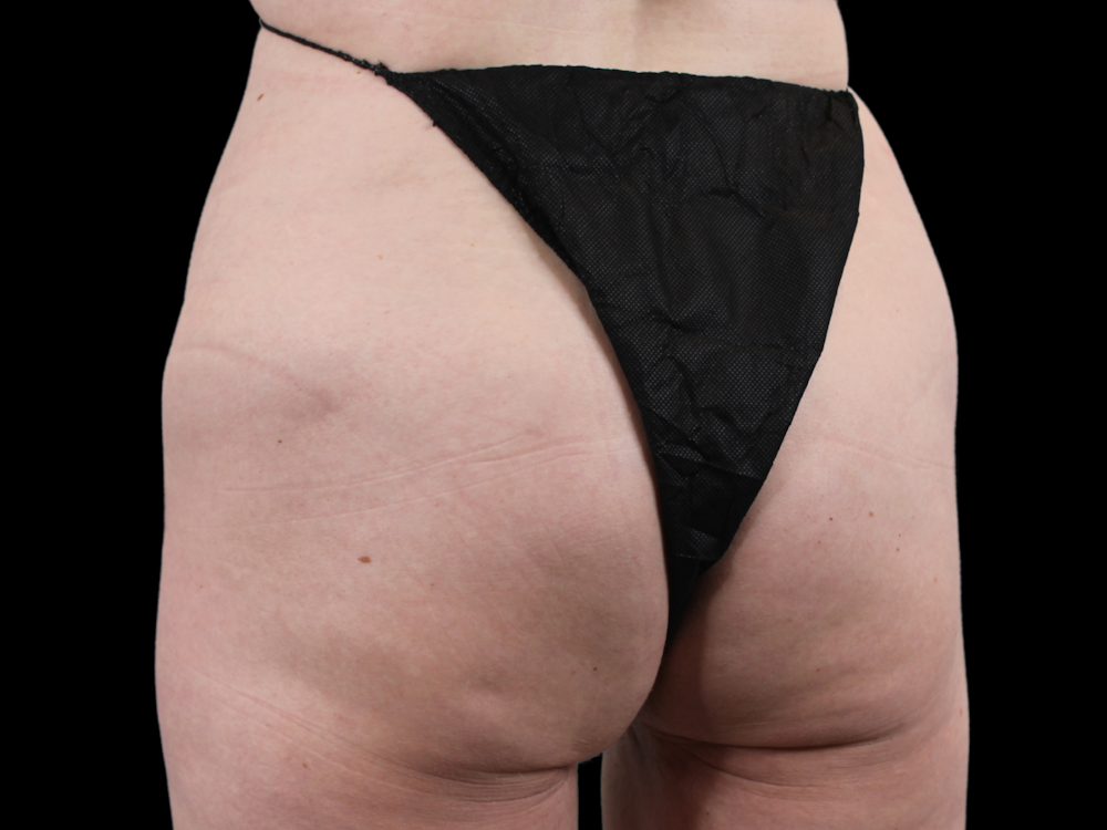 QWO Before & After Gallery - Patient 53828573 - Image 4