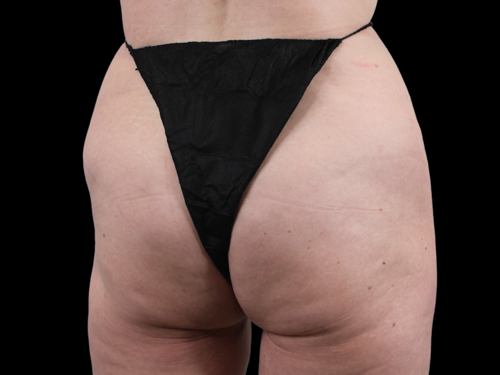 QWO Before & After Gallery - Patient 53828573 - Image 6