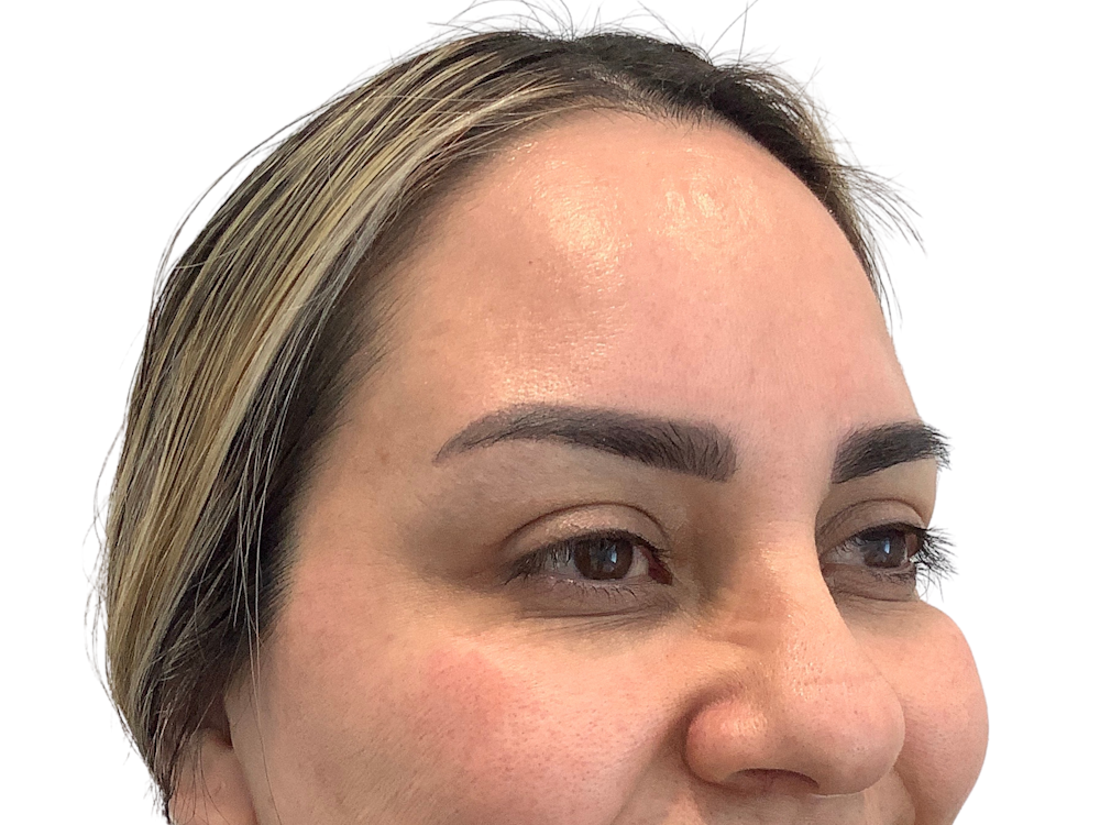 BOTOX  Before & After Gallery - Patient 53828873 - Image 2