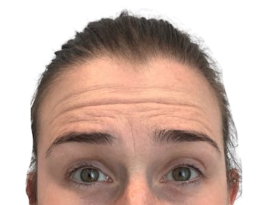 BOTOX  Before & After Gallery - Patient 53828874 - Image 1