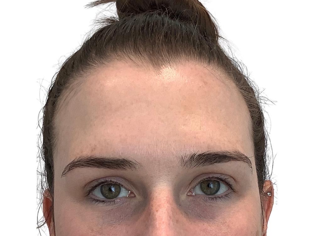 BOTOX  Before & After Gallery - Patient 53828874 - Image 2