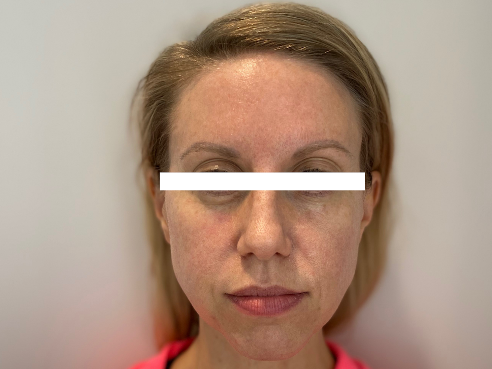 Cheek Filler  Before & After Gallery - Patient 53828952 - Image 2