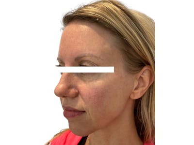 Cheek Filler  Before & After Gallery - Patient 53828952 - Image 4